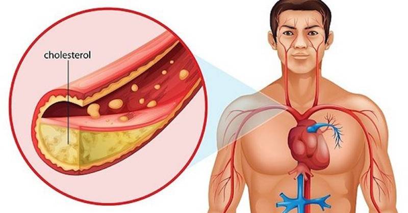 Cholesterol là gì và tại sao cần kiểm soát?